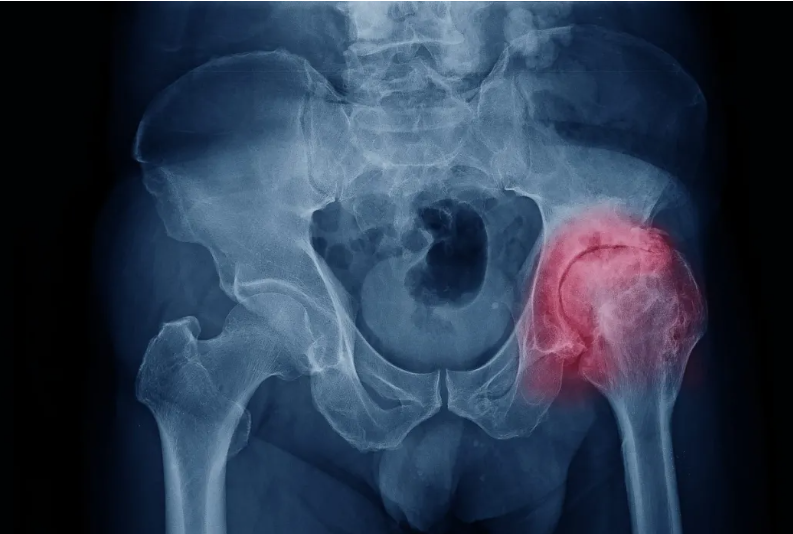 干细胞治疗股骨头坏死的案例，骨髓间充质干细胞与股骨头坏死